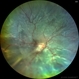 Retinal Detachment post ROP Retinal Detachment post ROP