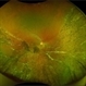 Self-Settled Retinal Detachment Self-Settled Retinal Detachment