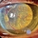 Neovascular Glaucoma Neovascular Glaucoma