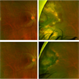 Peripheral VPT Pre and Post Treatment Peripheral VPT Pre and Post Treatment