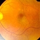 Choroidal Hemangioma