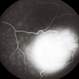 Retinal Capillary Hemangioblastoma Retinal Capillary Hemangioblastoma
