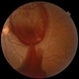 Retrohyaloid Premacular Hemorrhage Treatment