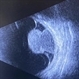 Echoes of Malignancy: Mushroom-Pattern Uveal Melanoma Echoes of Malignancy: Mushroom-Pattern Uveal Melanoma