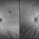 Congenital Retinal Pigment Epithelial Hypertrophy (CHRPE) Associated with Gardner's Syndrome Congenital Retinal Pigment Epithelial Hypertrophy (CHRPE) Associated with Gardner's Syndrome