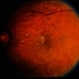 BDR / Macular Edema / Macroaneurysm BDR / Macular Edema / Macroaneurysm
