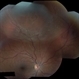 Asymptomatic Superior Retinal Detachment