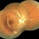 Traumatic Macular Hemorrhage Traumatic Macular Hemorrhage