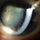 Retention of Perfluorocarbon in Anterior Chamber Retention of Perfluorocarbon in Anterior Chamber