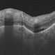 OCT Choroidal Tuberculoma