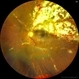 Cheese Pizza Pie Appearance in CMV Retinitis Cheese Pizza Pie Appearance in CMV Retinitis