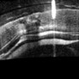 Luxated lens to anterior segment