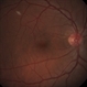 BRAO d/t cat scratch disease - RE fundus photograph