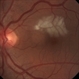 BRAO d/t cat scratch disease - LE fundus photograph