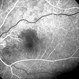 BRAO d/t cat scratch disease - FA 00:18 min.