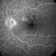 BRAO d/t cat scratch disease - FA 5:23 min.