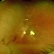 Traumatic Macular Hole Closed With Amniotic Membrane Graft Traumatic Macular Hole Closed With Amniotic Membrane Graft