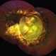 Chorioretinal coloboma involving disc and macula Chorioretinal coloboma involving disc and macula