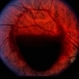 Terson's Syndrome Terson's Syndrome