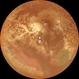 Vitreous Cyst With Vitreous Hemorrhage in a Case of Retinitis Pigmentosa Vitreous Cyst With Vitreous Hemorrhage in a Case of Retinitis Pigmentosa