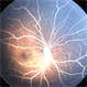 Lipemia Retinalis Lipemia Retinalis