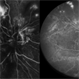 Combined Occlusion with TRD Combined Occlusion with TRD