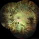 Sympathetic Ophthalmia Sympathetic Ophthalmia