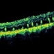 Retinal Folds Following Retinal Reattachment Surgery Retinal Folds Following Retinal Reattachment Surgery