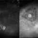 FA/ICG of Retinal Vasoproliferative Tumor FA/ICG of Retinal Vasoproliferative Tumor