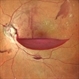 Pre Retinal Hemorrhage Pre Retinal Hemorrhage