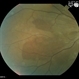 Choroidal Hemorrhage from Hypertensive  Choroidopathy