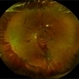 Proliferative Diabetic Retinopathy Proliferative Diabetic Retinopathy