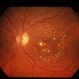 Dry AMD Dry AMD