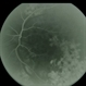 Venous Stasis Retinopathy Venous Stasis Retinopathy
