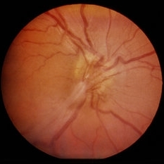 Toxocara - Retina Image Bank