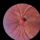 Melanocytoma of Optic Nerve Head Melanocytoma of Optic Nerve Head