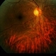 Necrotizing Retinitis Necrotizing Retinitis