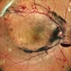 SUBHYALOID HEMORRHAGE