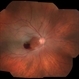 Arterial Occlusion With Preservation of Cilioretinal Network