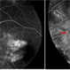 Leber's Miliary Aneurysms