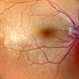 Lymphoma Lesion at the Posterior Pole Lymphoma Lesion at the Posterior Pole