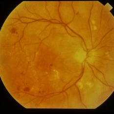 Heme Exudate Ischemia From Multiple Myeloma - Retina Image Bank