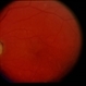 Sturge-Weber / Choroidal Hemangioma