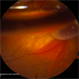 Sub Retinal Gas 1 Day Post Pneumatic Retinopexy