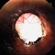 Optic Disc Coloboma Optic Disc Coloboma