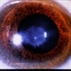 Wilson's Disease Wilson's Disease