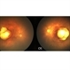 Macular Colobomas in Congenital Zika Syndrome Macular Colobomas in Congenital Zika Syndrome