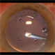 Air Bubbles behind Posterior Capsule and Intra-Ocular Lens in the Anterior Hyaloid Phase during Vitrectomy Retina Surgery Air Bubbles behind Posterior Capsule and Intra-Ocular Lens in the Anterior Hyaloid Phase during Vitrectomy Retina Surgery