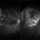 FA Malignant Melanoma FA Malignant Melanoma
