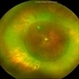 Scleral buckle indent s/p retina surgery Scleral buckle indent s/p retina surgery